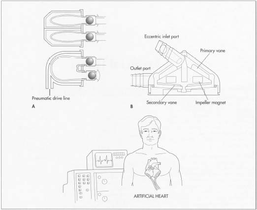 A. A pneumatic artificial heart. B. A gyro centrifugal artificial heart.
