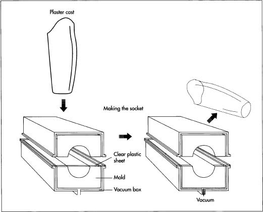 After a plaster cost of the amputee's stump is made, a thermoplastic sheet is vacuum-formed around this cast to form a test socket. In vacuum-forming, the plastic sheet is heated and then placed in a vacuum chamber with the cost (or mold). As the air is sucked out of the chamber, the plastic adheres to the cast and assumes its shape. After testing, the permanent socket is formed in the some way.