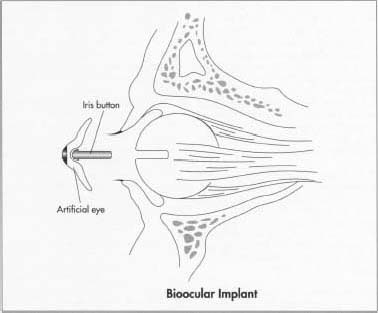 For a bioocular implant, the surgeon makes an incision around the iris and then removes the contents of the eyeball. A ball made of some inert material such as plastic, glass, or silicone is then placed inside the eyeball and the wound is closed.