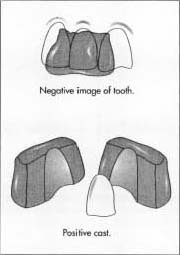 An impression of the tooth to be crowned is taken to record its shape. The impression plaster is mixed and then placed in a tray that is fitted over the teeth. The tray is held still in place until the plaster hardens. When the tray is removed from the mouth, it retains a three dimensional impression of the tooth that is to be covered. This impression is a negative, or reverse, image of the tooth.