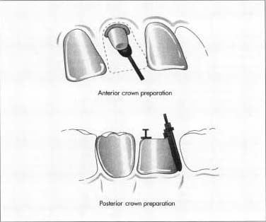 Two types of crown preparation: anterior and posterior.