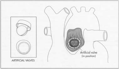 Artificial heart valves consist of an orifice, through which blood flows, and a mechanism that closes and opens the orifice.