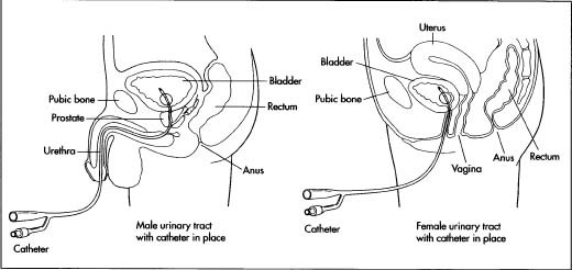 An example of how a Foley catheter is inserted into the male and female urinary tract.