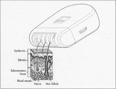 An epilation device that pulls the hair out at the root.